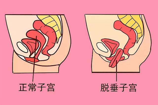 盆底肌无力与子宫脱垂能否正常怀孕