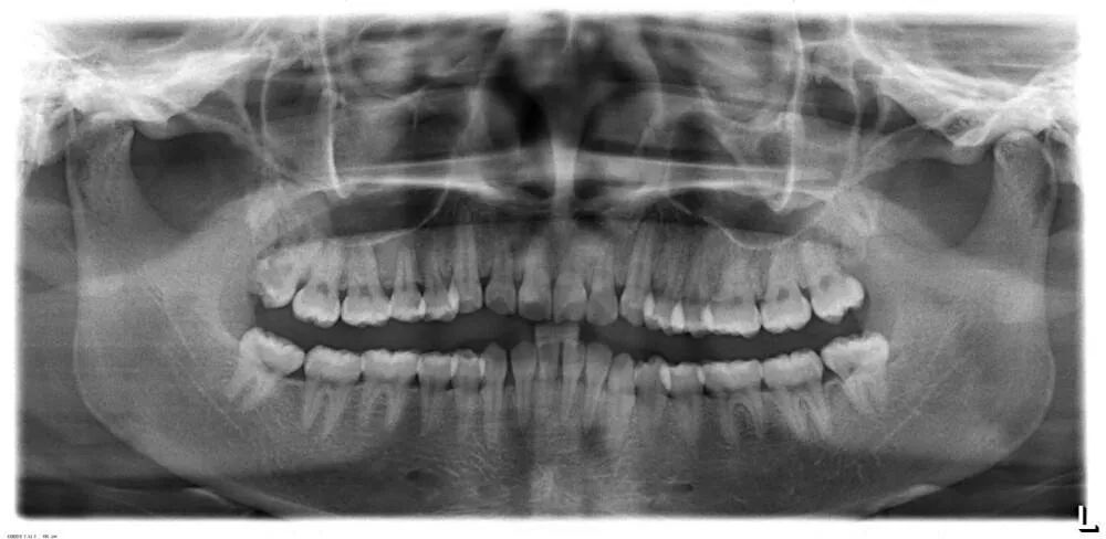 以口腔全景片为例,顾名思义就是可以把全口牙齿都展现出来的一种牙片.