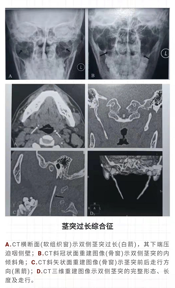 茎突综合征是指由于茎突过长,茎突声像方向异常,形态异常,茎突舌骨