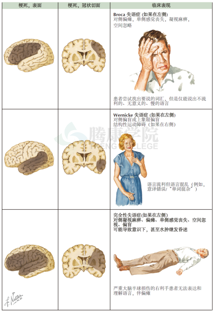 上表列出了主要类型的失语症的解剖学定位和临床表现,包括broca(表达