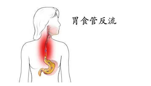 胃反酸烧心八招拯救反酸的胃