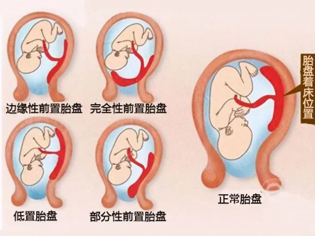 前置胎盘附着的位置挡住了胎儿娩出的通道,多数孕妇只能借助剖宫产