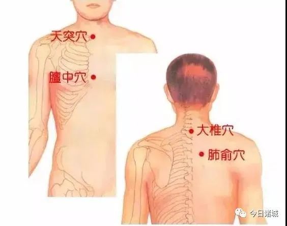 穴位的采纳,根据中医辨证论治与经络循行等特点,选定"天突,膻中,大椎