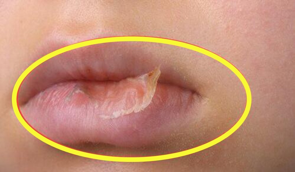 冬季宝宝嘴唇干裂起皮还出血我用两个方法护理比喝水管用