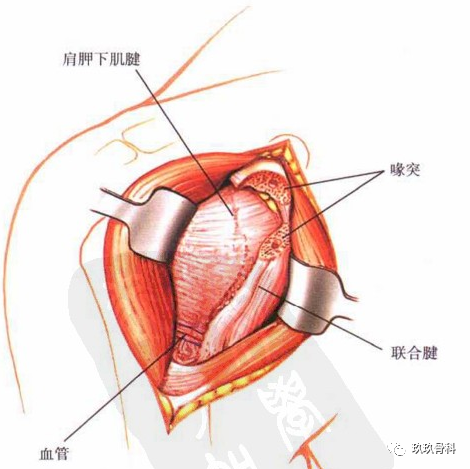 截断喙突前先在喙突顶端钻孔.沿联合腱外侧切开肩胛下肌表面筋膜.