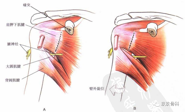 骨科小技巧肩关节前侧入路详解