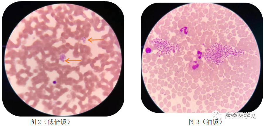 低倍镜下先观察全片情况,再转换到油镜下观察血涂片尾部及血涂片两侧