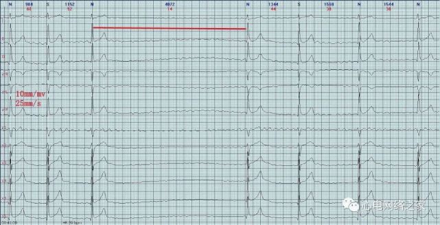 心电图病例分析35:心房颤动伴短暂心室停搏
