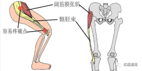髋股膝外侧疼痛阔筋膜张肌髂胫束损伤