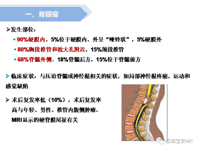 脊髓外硬膜下肿瘤的影像表现