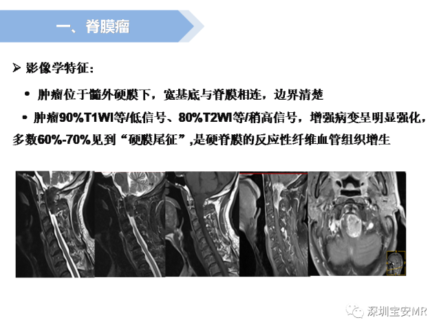 脊髓外硬膜下肿瘤的影像表现