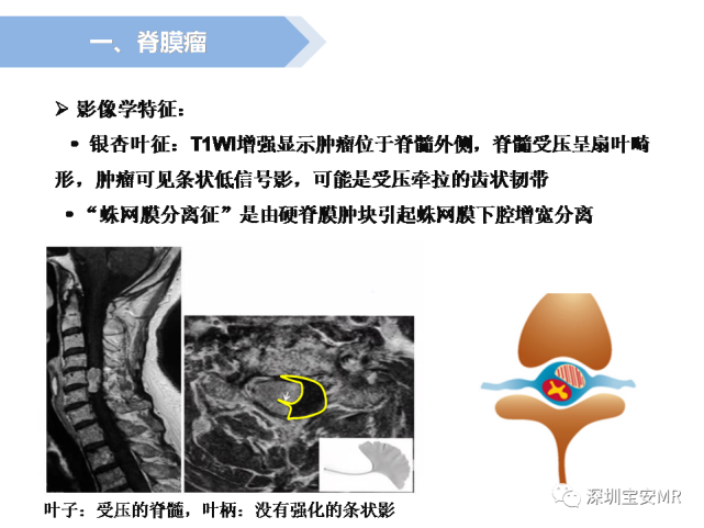 脊髓外硬膜下肿瘤的影像表现