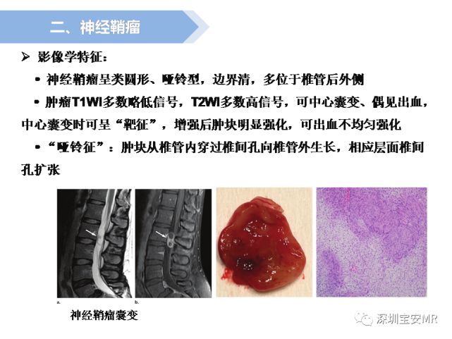 脊髓外硬膜下肿瘤的影像表现