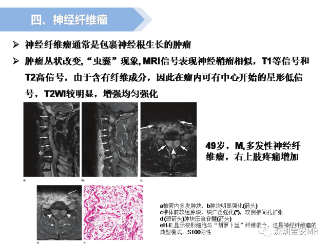 脊髓外硬膜下肿瘤的影像表现