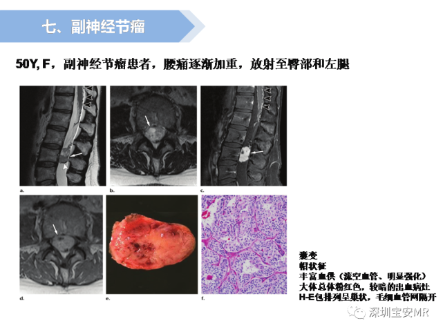 脊髓外硬膜下肿瘤的影像表现