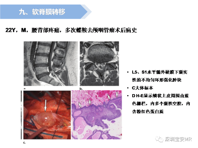 脊髓外硬膜下肿瘤的影像表现