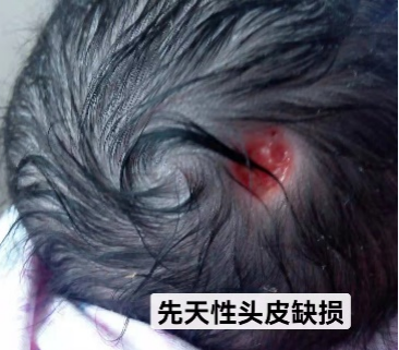 举例说明是先天性畸形还是医疗事故新生儿的头皮怎么没了一块