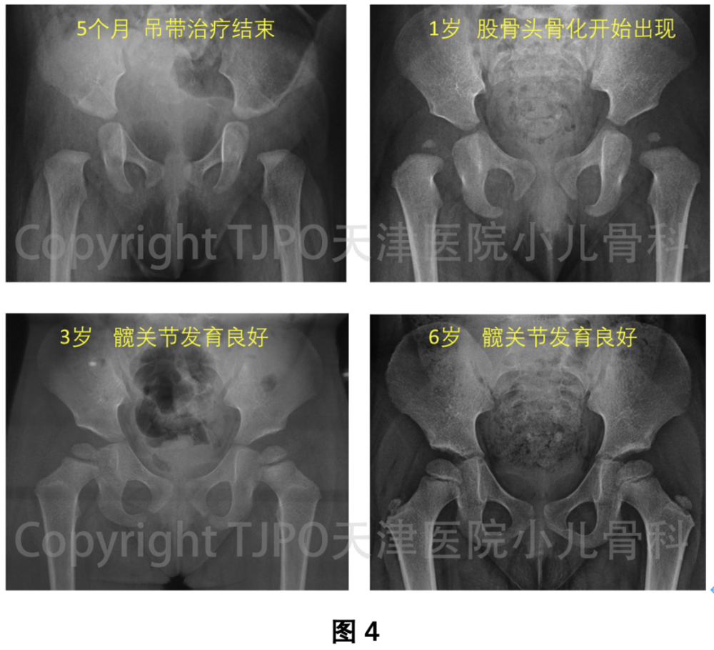 tjpo儿童ddh科普1如果髋关节发育不良能够早期被发现髋关节可以发育到