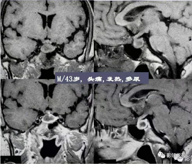 垂体解剖及常见病变影像学表现
