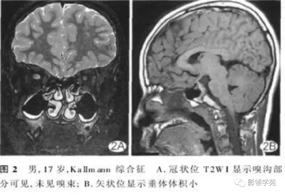 垂体解剖及常见病变影像学表现