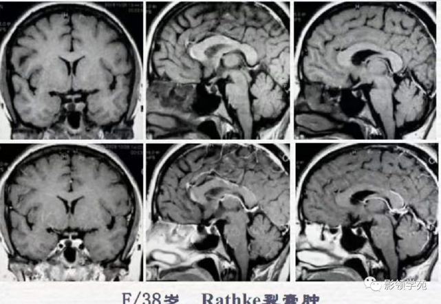 垂体解剖及常见病变影像学表现