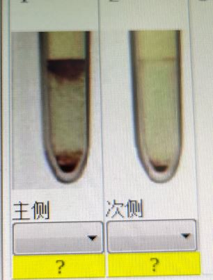 1例盐水间接抗人球蛋白试验鉴别交叉配血假凝集