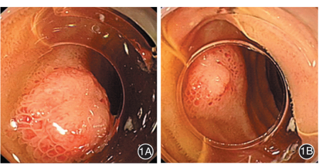 【202112病例】内镜黏膜下剥离术切除早期回肠癌一例