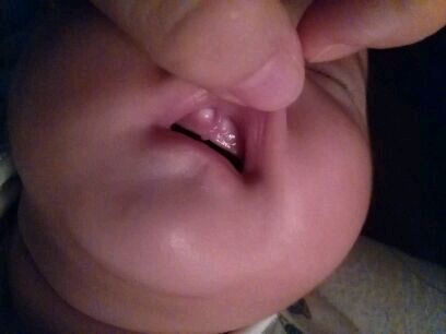 如果新生儿出现口腔内两颊部帮助吮吸的脂肪层,这个医学上称为颊脂体