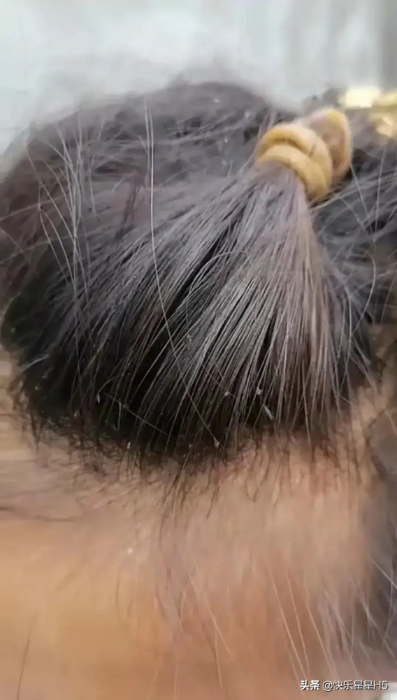 在爷爷奶奶照顾下女孩儿头发上长满了虱子