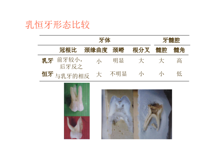 亚髓腔形态牙体形态乳牙解剖的形态乳牙解剖形态与组织结构特点乳牙预