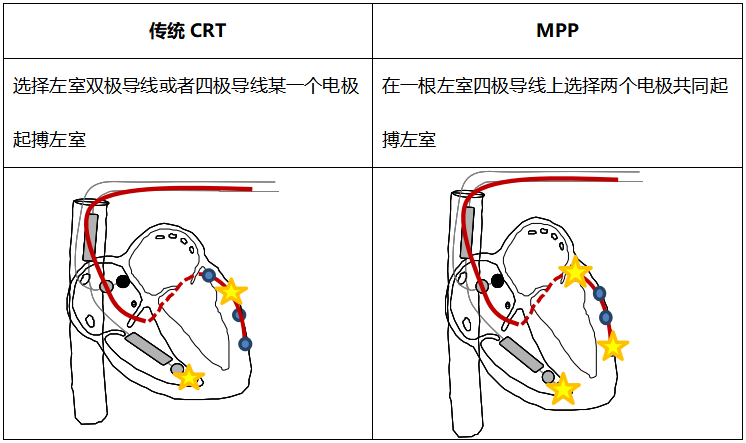 精彩病例丨cdqi名家面对面第六十四期一例宽qrs波心衰患者的起搏器