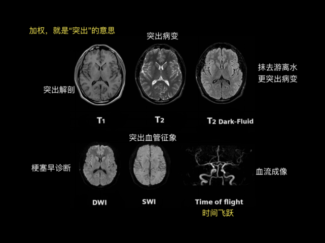 基底节区海马脑干:延髓,脑桥,中脑面神经,听神经,三叉神经颅脑 mri 矢