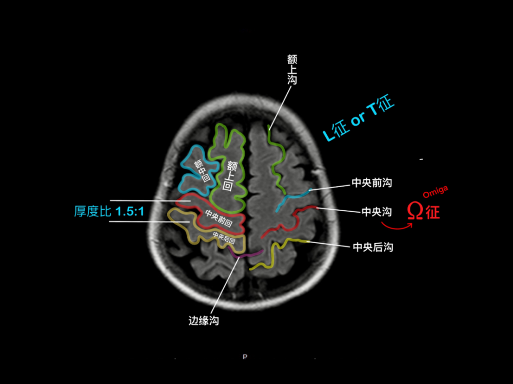 神经,三叉神经颅脑 mri 矢状位垂体瘤颅脑 mri颅脑 mrv鞍上池,脚间池