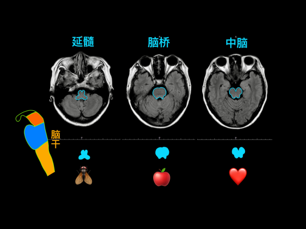 脑干:延髓,脑桥,中脑面神经,听神经,三叉神经颅脑 mri 矢状位垂体瘤