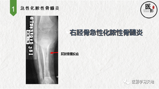 急性化脓性骨髓炎影像表现