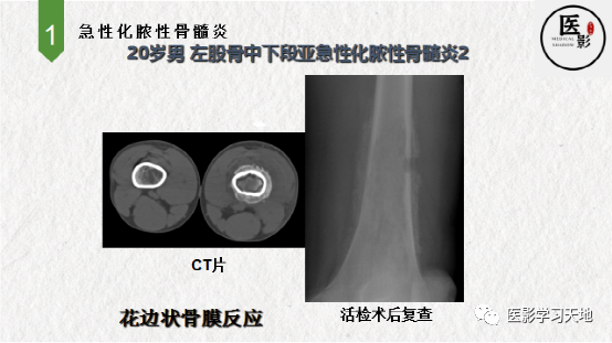 急性化脓性骨髓炎影像表现