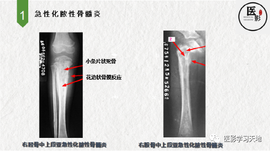 急性化脓性骨髓炎影像表现