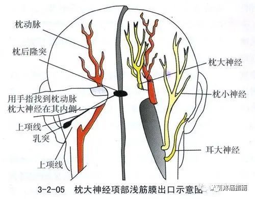 偏头痛之枕大神经卡压