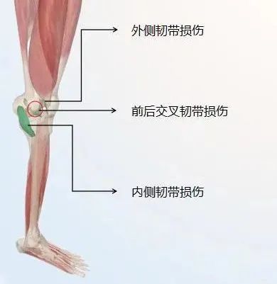 常见的有半月板损伤,前后交叉韧带损伤,内外侧韧带损伤.