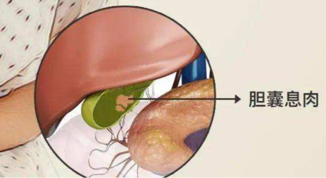 体检无意查出胆囊息肉?这样做或可不手术缩小消除息肉!