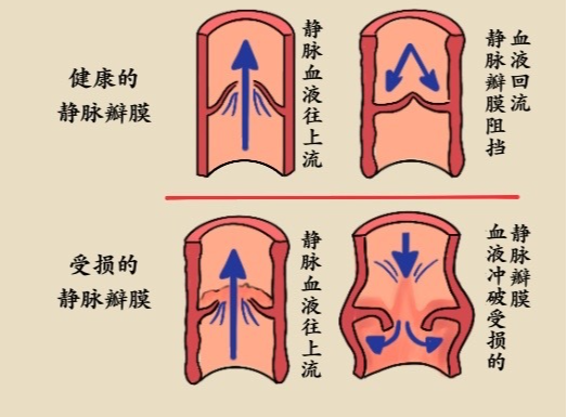 静脉曲张能药物治疗吗|静脉|药物|静脉瓣|瓣膜|静脉曲张