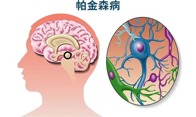 帕金森病的表现及护理|帕金森病|震颤