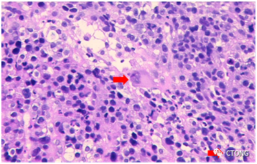 iiic期nsclc 两线治疗无效后的治疗决策|广东大会诊