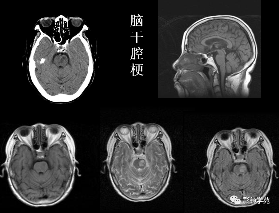 10种脑干区常见病变影像表现一文总结