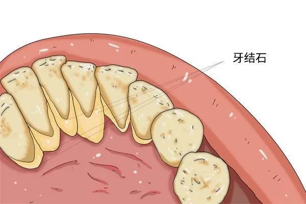 有牙结石该怎么去除教你清除牙缝中的小石头