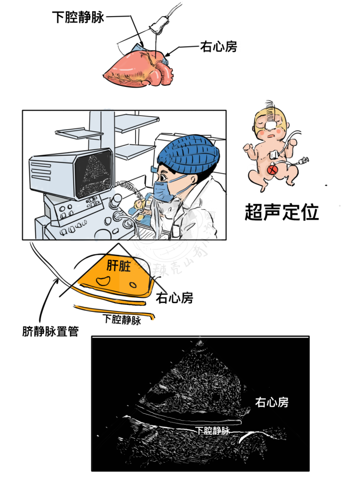 早产儿成长记脐静脉置管