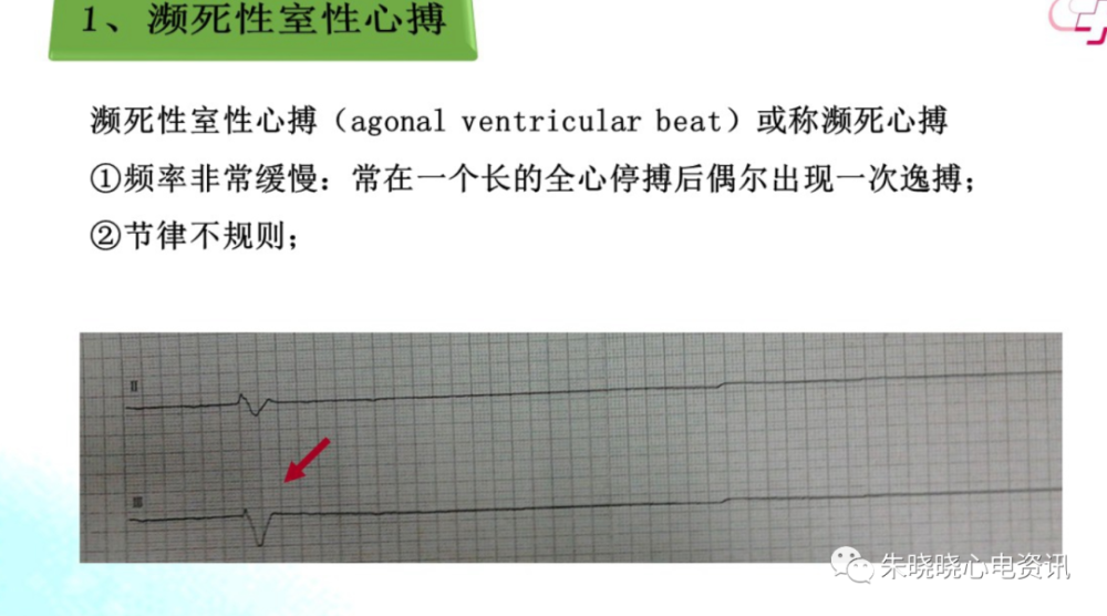 濒死心电图特点