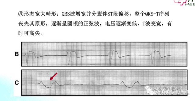 濒死心电图特点