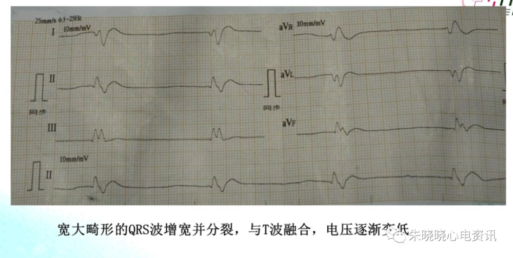 濒死心电图特点