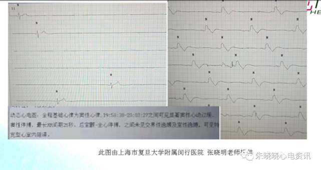 濒死心电图特点